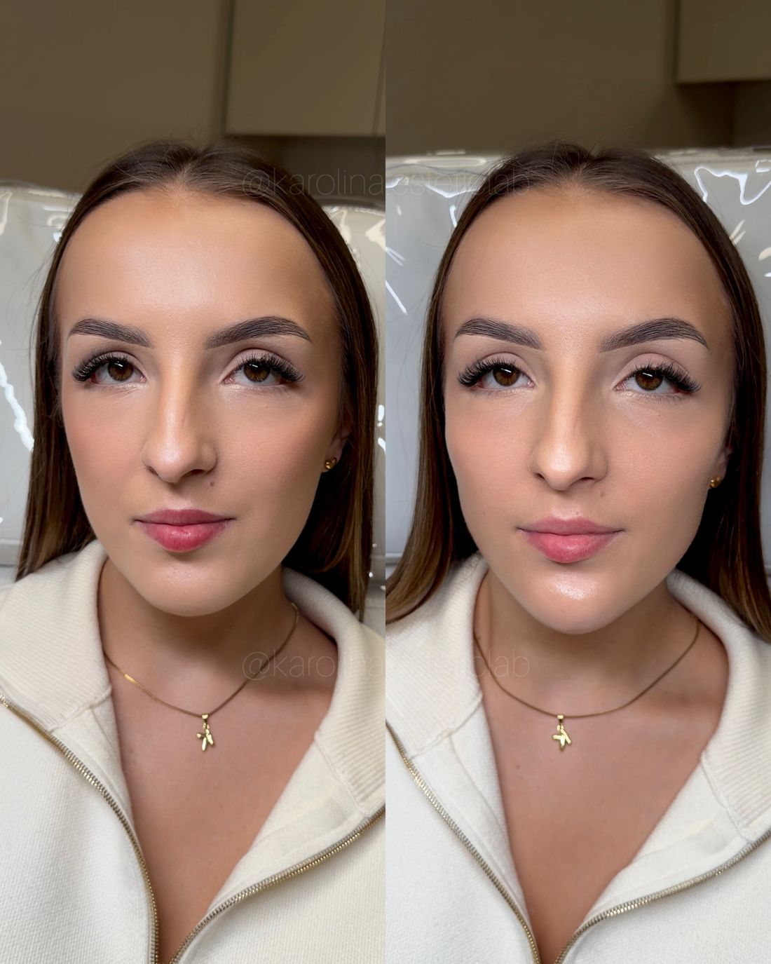 Efekt zabiegu w esteticlab: Wolumetria