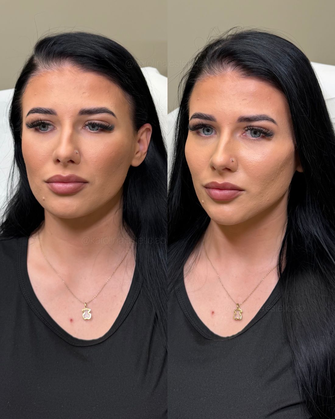 Efekt zabiegu w esteticlab: Full face