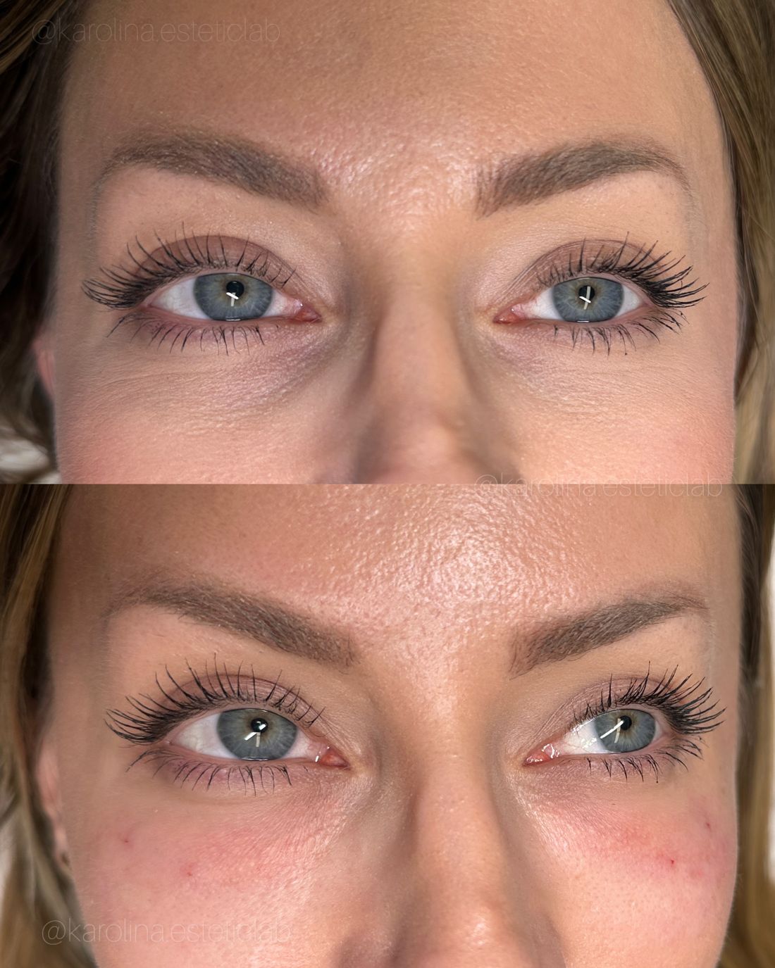 Efekt zabiegu w esteticlab: Okolica oczu