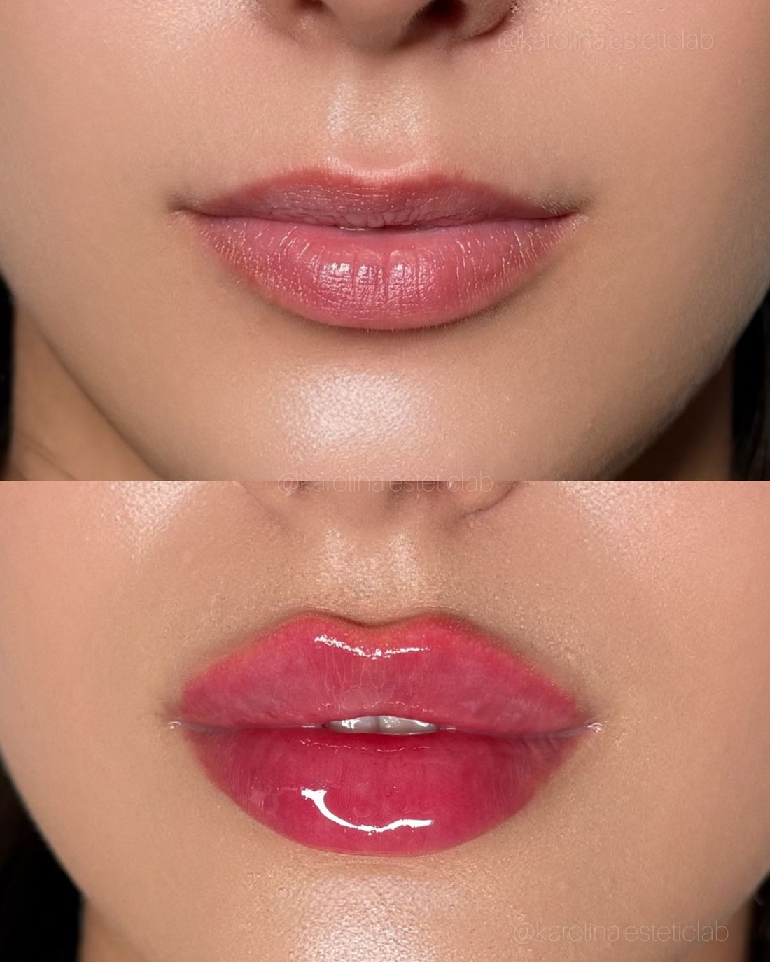 Efekt zabiegu w esteticlab: Usta