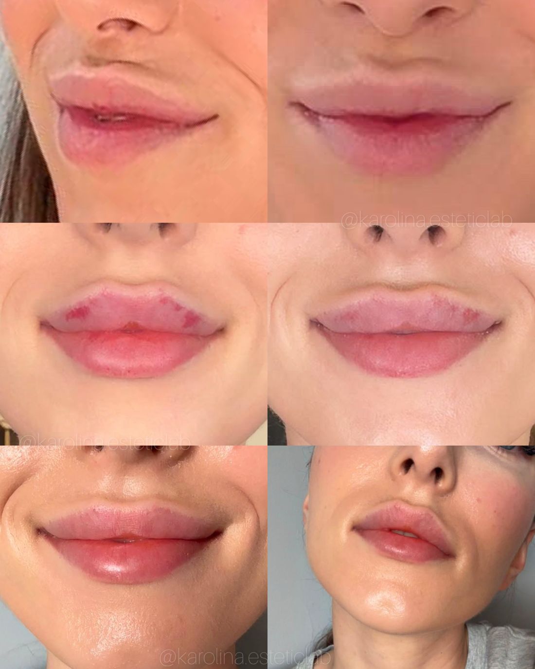 Efekt zabiegu w esteticlab: Usta