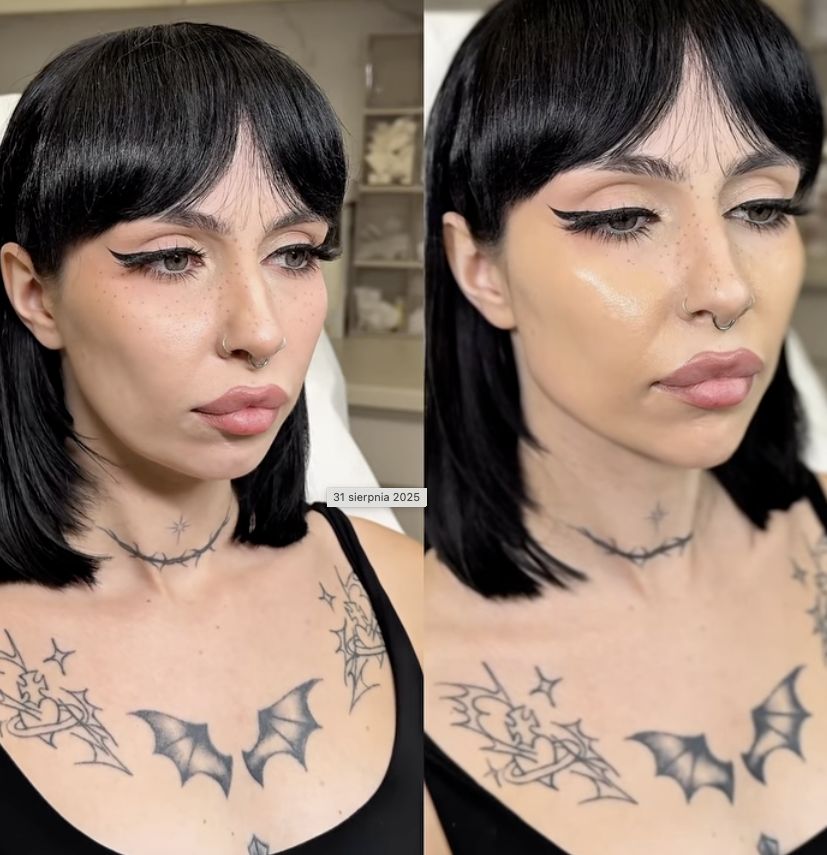 Efekt zabiegu w esteticlab: Usta